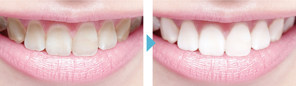 従来のホワイトニングとの違い