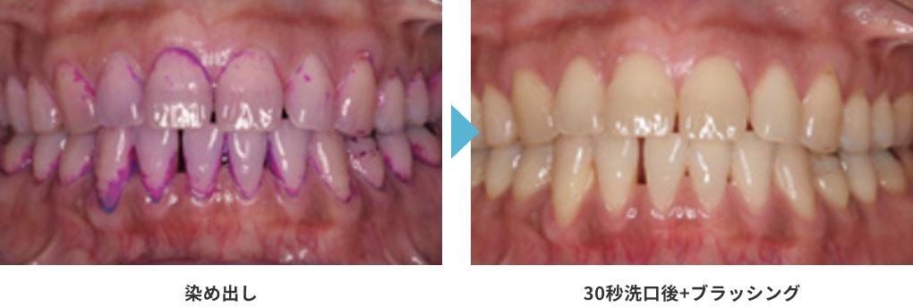 染め出し／30秒洗口後+ブラッシング