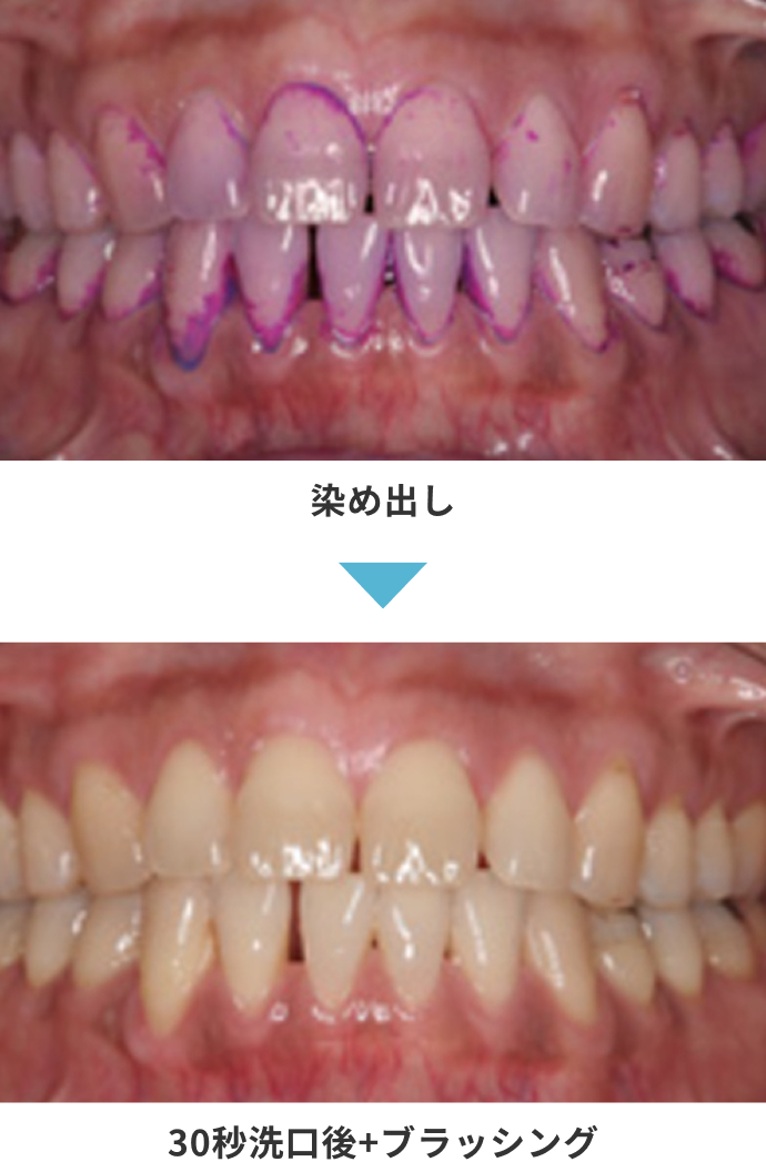 染め出し／30秒洗口後+ブラッシング