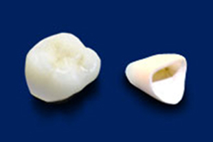 オールセラミックス(ガラス系)