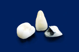 硬質レジン前装冠