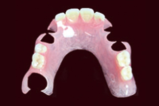 ノンクラスプデンチャー
