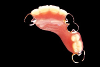 ノンクラスプデンチャー+金属フレーム